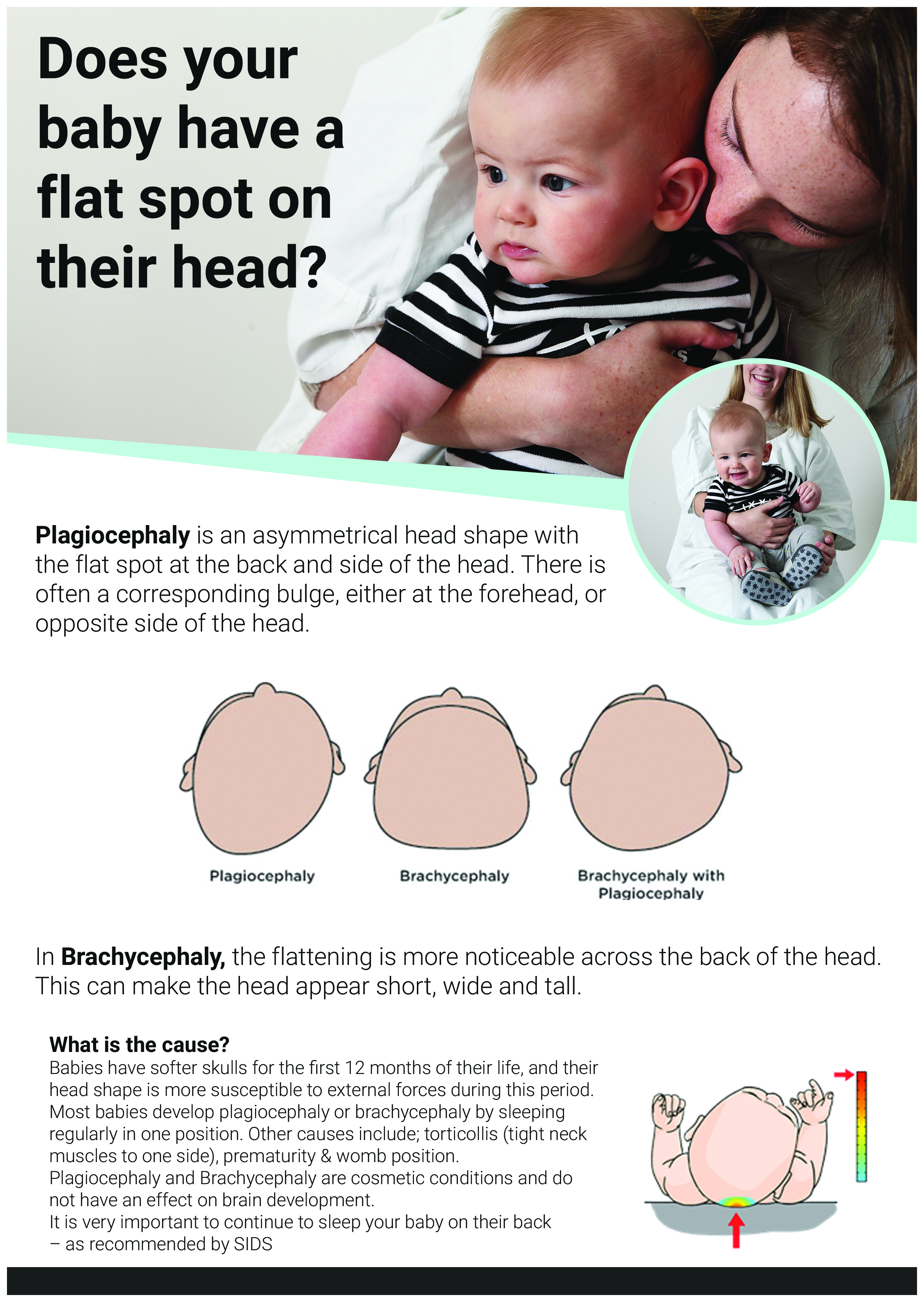 Assessment and evaluation for baby's flat head plagiocephaly