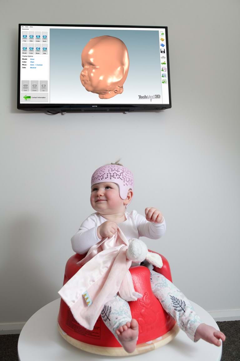 Plagiocephaly Helmet Custom made, 3D Printed in Melboune