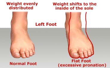 Flat Feet and Over-Pronation