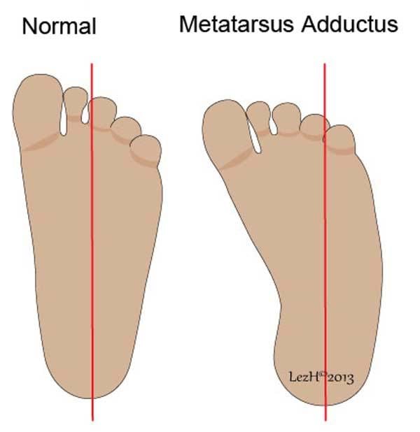 Metatarsus Adductus